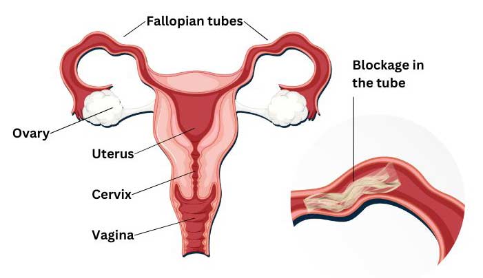 Blocked fallopian tubes