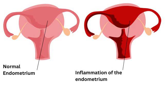 Inflammation of the endometrium