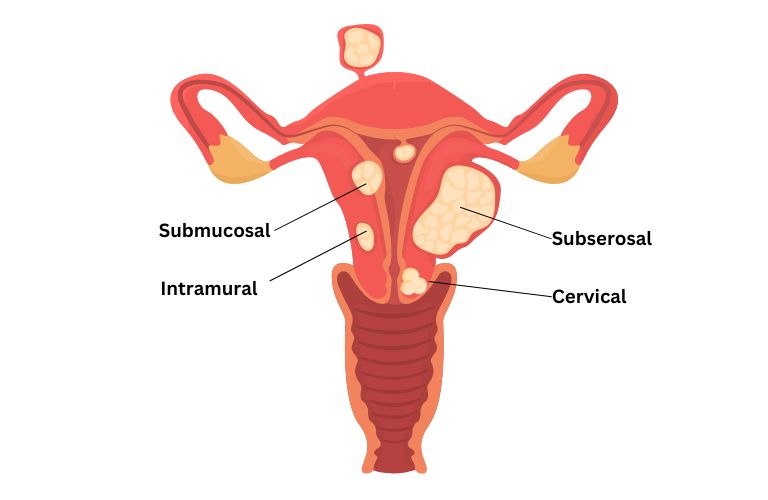 Types of fibroids